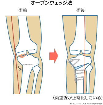 オープンウェッジ法