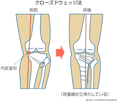 クローズドウェッジ法