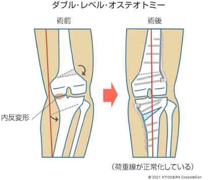 ダブル･レベル･オステオトミー