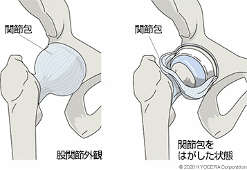 股関節外観 関節包をはがした状態