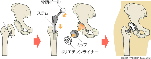 人工股関節置換術の例