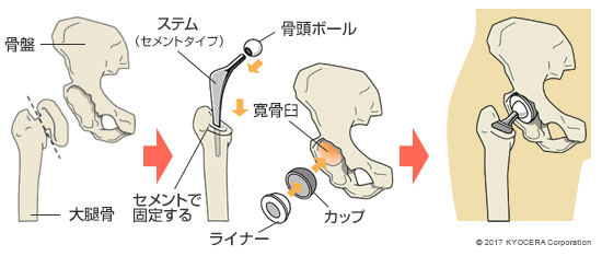 セメントタイプの人工股関節置換術の例