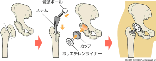 後述するセメントレスタイプの人工股関節置換術の例