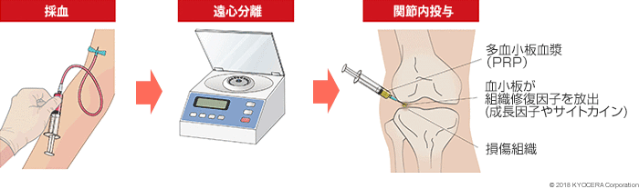 PRP療法イメージ図