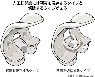 人工膝関節には靱帯を温存するタイプと切除するタイプがある