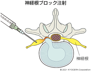 神経根ブロック注射