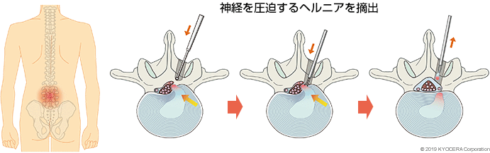 神経を圧迫するヘルニアを摘出