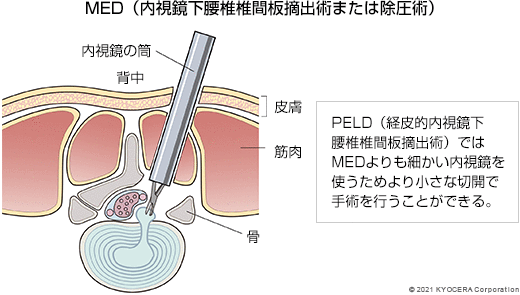 MED（内視鏡下腰椎椎間板摘出術または除圧術）