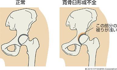 正常 寛骨臼形成不全