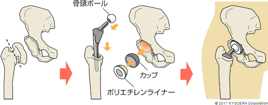 後述するセメントレスタイプの人工股関節置換術の例