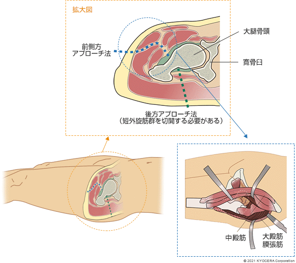 前側方アプローチ法 後方アプローチ法（短外旋筋群を切開する必要がある）