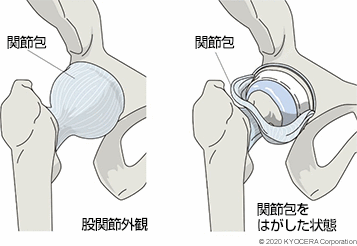 股関節外観 関節包をはがした状態 関節包