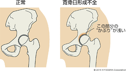 正常 寛骨臼形成不全