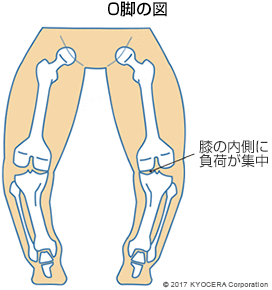 O脚の図