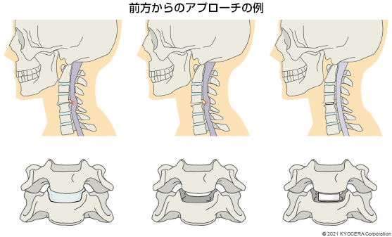 前方からのアプローチの例