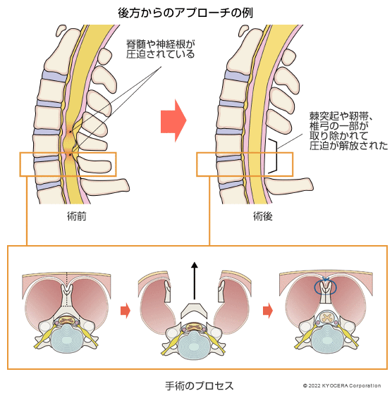 除圧術 後方からのアプローチの例