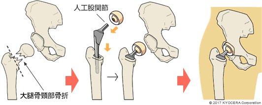 人工骨頭置換術の例