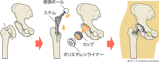 人工股関節置換術の例