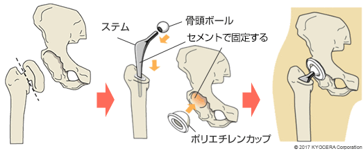 セメントタイプの人工股関節置換術の例