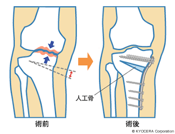 脛骨骨切り術