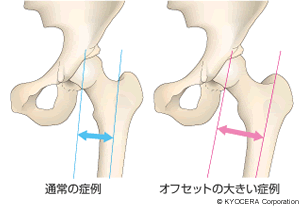 オフセットの症例