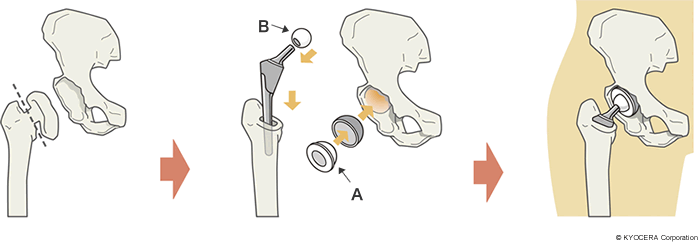 ポリエチレンのライナー（下図Aの部分）とアルミナ・セラミックの骨頭（下図Bの部分）