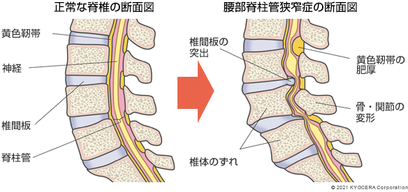正常な脊椎の断面図 腰部脊柱管狭窄症の断面図