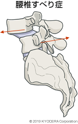 腰椎すべり症