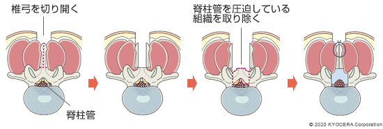 椎弓形成術