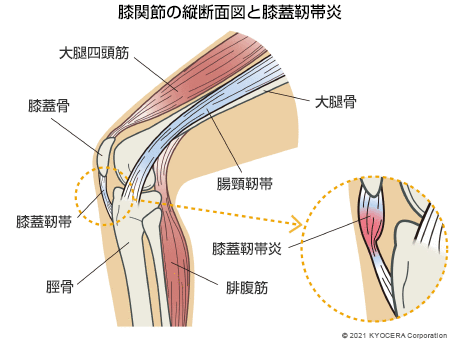 膝関節の縦断面図と膝蓋靭帯炎