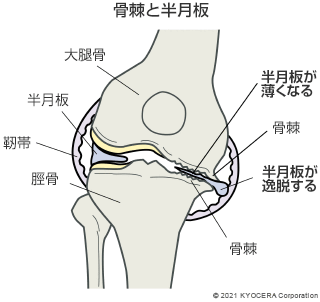 骨棘と半月板