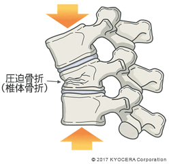圧迫骨折（椎体骨折）