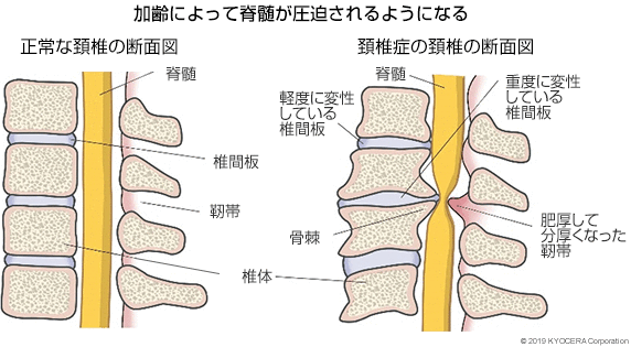 加齢によって脊髄が圧迫されるようになる