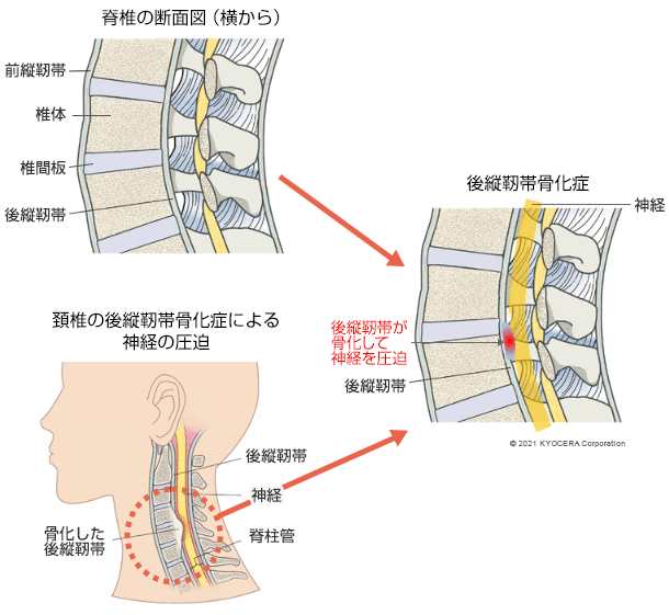 後縦靱帯骨化症