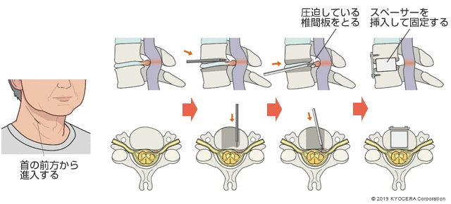 前方アプローチの例