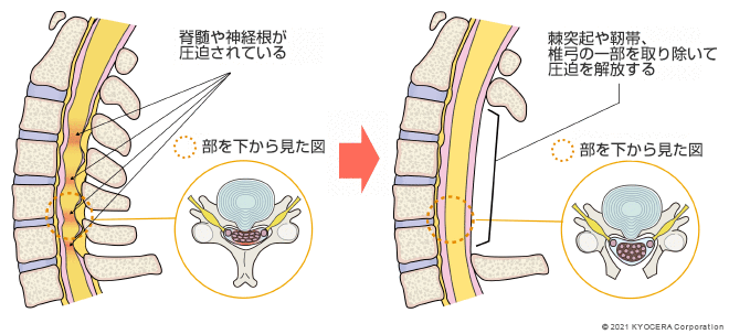 後方アプローチの例