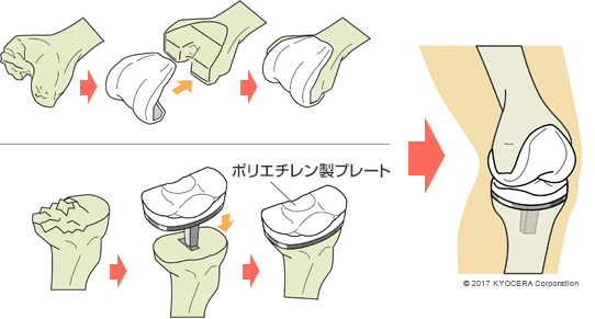 人工膝関節全置換術（TKA）の例