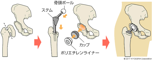 人工股関節全置換術（THA）の例