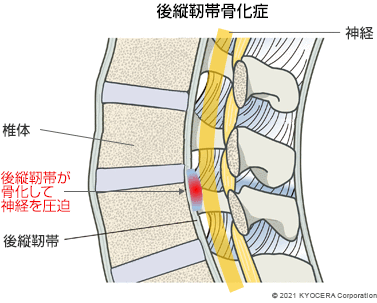 後縦靭帯骨化症