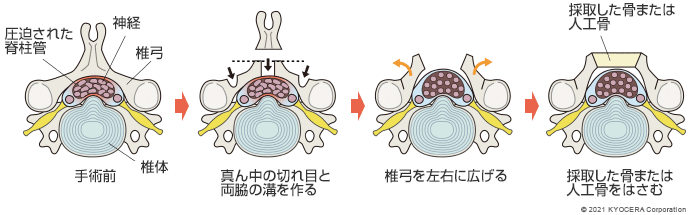 椎弓形成術の例