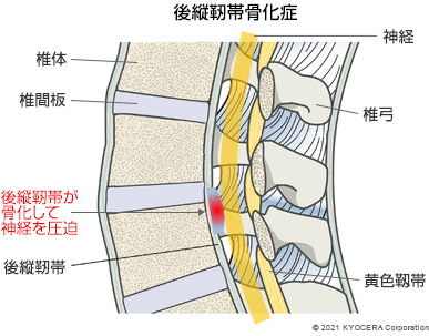 後縦靭帯骨化症