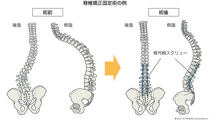  脊椎矯正固定術の例