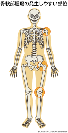 骨軟部腫瘍の発生しやすい部位