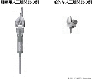 腫瘍用人工膝関節の例 一般的な人工膝関節の例