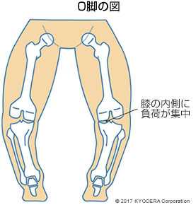 O脚の図