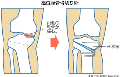 高位脛骨骨切り術