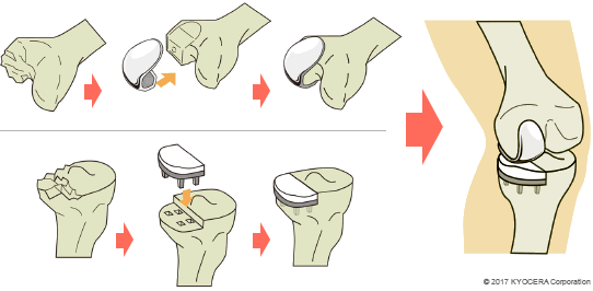 人工膝関節単顆置換術（UKA）の例