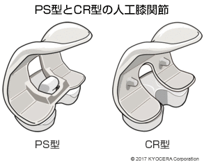 PS型とCR型の人工膝関節