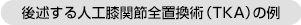 後述する人工膝関節全置換術（TKA）の例