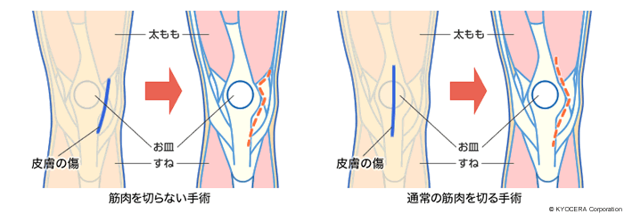 MISの切開イメージ